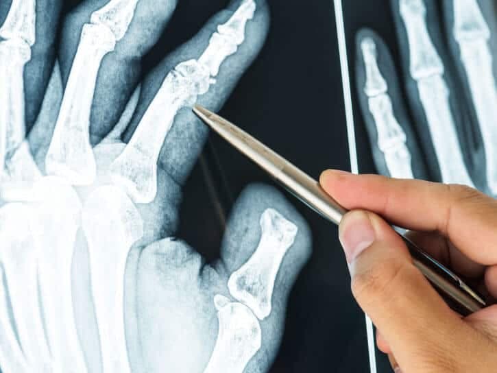 bone-x-ray